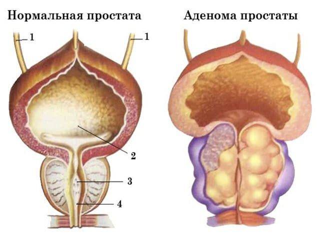 giperplaziya_predstatelnoj_zhelezy1