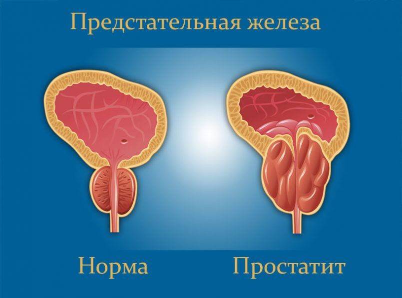 kak-bolit-mochevoy-puzyr-simptomy-u-zhenshhin-12