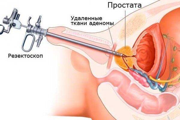 kak-vosstanovit-potenciyu-posle-udaleniya-prostaty-pri-rake-prostaty-preparaty-in-ekcii-1