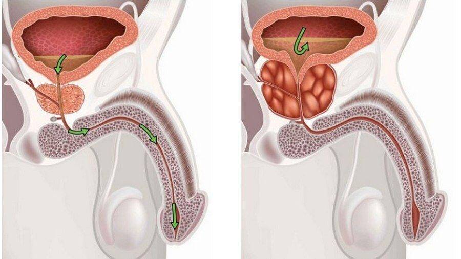 kak-vyyavit-prostatita-u-muzhchin-kakie-analizy-2-1
