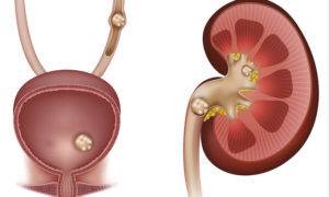 stones-in-the-kidney-urinary-bladder-and-ureter