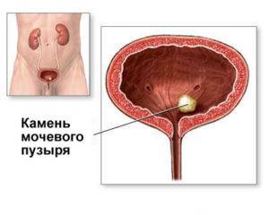 kamni-v-mochevom-puzyre-300x240-1