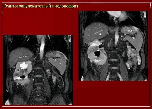 kt-priznaki-ksantogranulematoznogo-pielonefrita