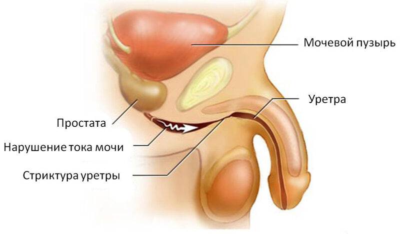 legkoe_zhzhenie_mocheispuskatelnom