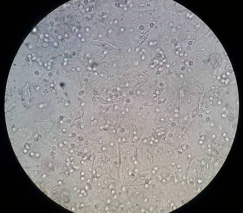 leukocytes-in-urine3