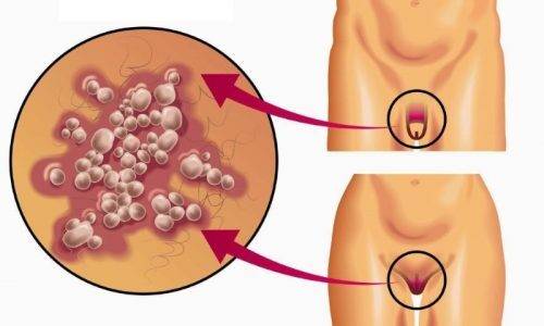 lokalizacija-genitalnogo-gerpesa-500x300-1
