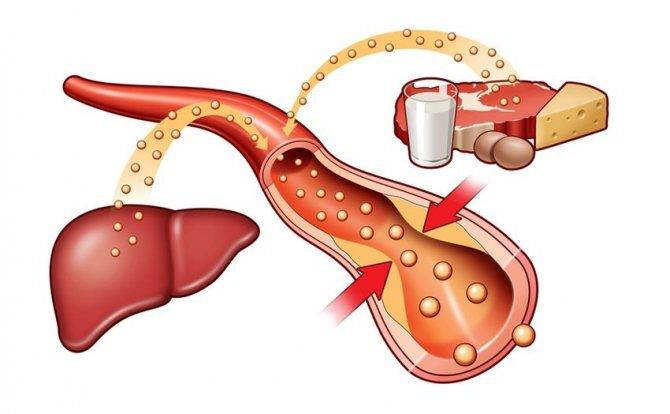 mehanizm-obrazovaniya-holesterinovyh-blyashek