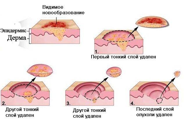 melanoma-na-rannih-stadiyah-priznaki-7