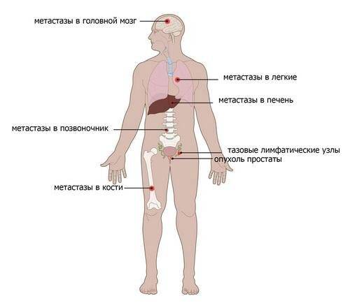 metastazy-pri-rake-predstatelnoj-zhelezy