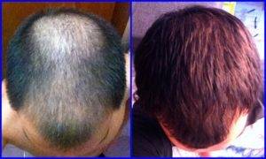 minoxidil-do-posle-300x180-1