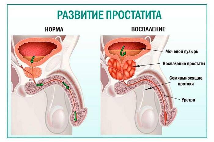 nastoyka-bobrovoy-strui-10