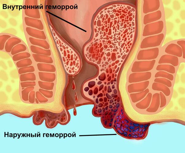 nastoyka-bobrovoy-strui-11