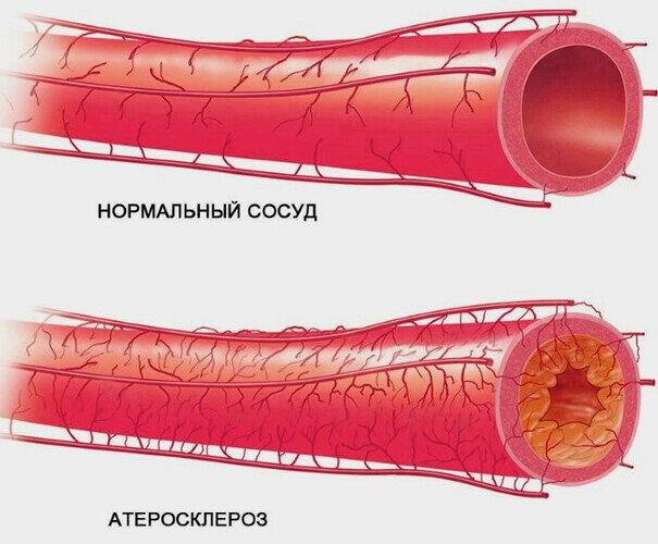 nastoyka-bobrovoy-strui-5