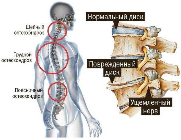 nevralgiya-spiny-1