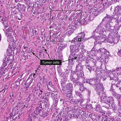 nizkodifferencirovannaya-adenokarcinoma-predstatelnoj-zhelezy