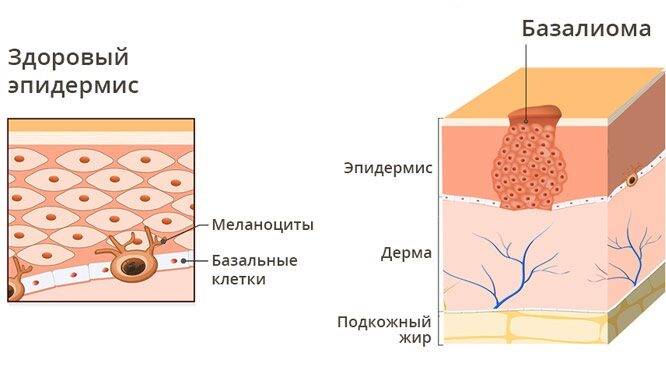 novoobrazovaniya-na-kozhe-1