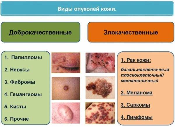 novoobrazovaniya-na-kozhe-2