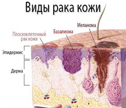 novoobrazovaniya-na-kozhe-5