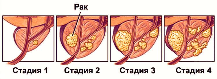 onkomarker-predstatelnoj-zhelezy2