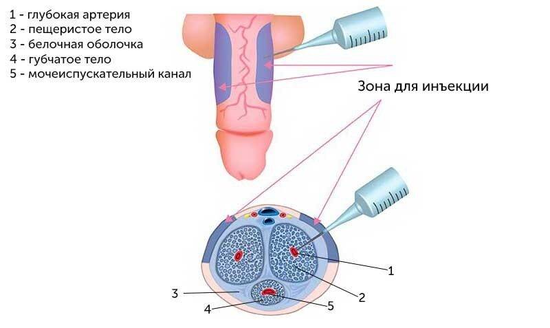 operatsiya-po-uvelicheniyu-chlena1