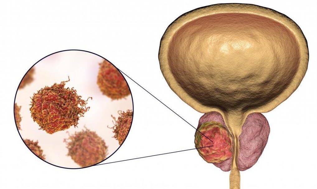 opuhol-prostaty-2