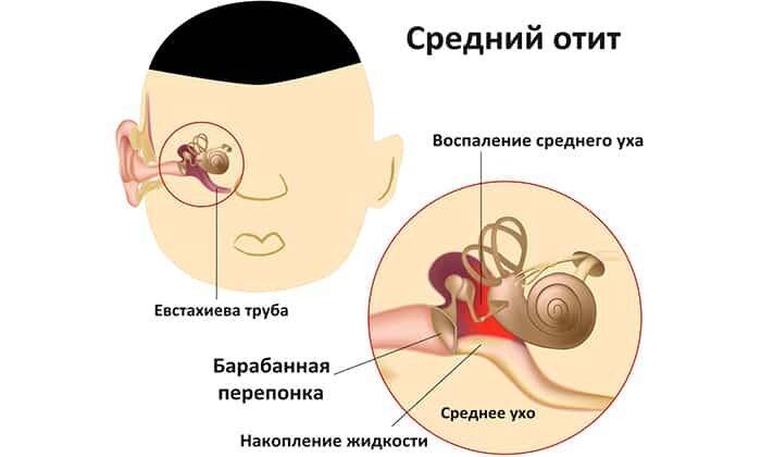 ostryy-sredniy-otit