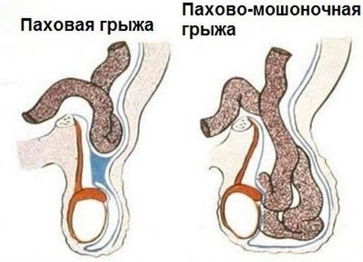 pahovo-moshonochnaya-gryzha