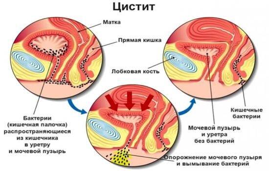 peredaetsya-li-cistit-polovym-putem-ot-zhenshchiny-k-muzhchine