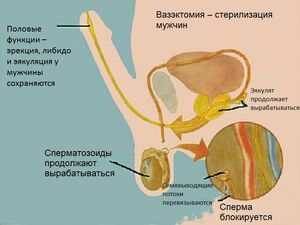 plyusy-i-minusy-sterilizatsii