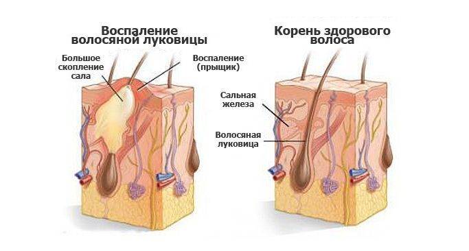 pojavlenie-pryshhej-na-golove