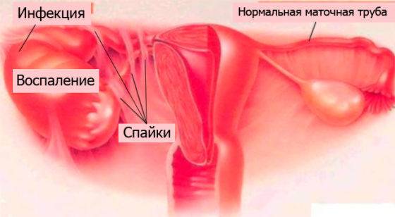 prichiny-neprohodimosti-matochnyh-trub-e1517410602604