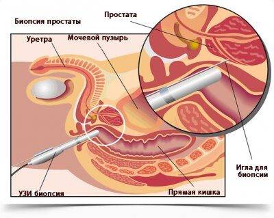 prostate-biopsy_400x319