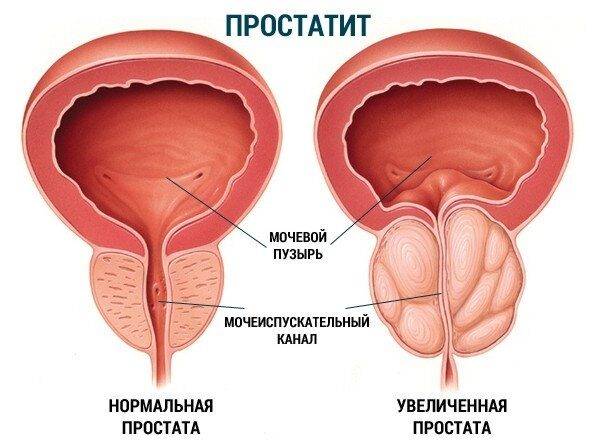 prostatit-1