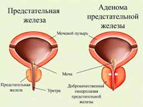 prostatit-4