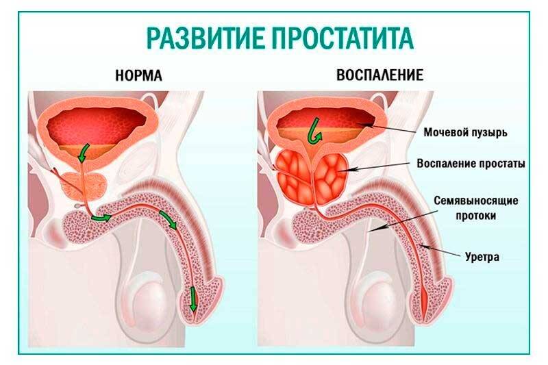 prostatit-7