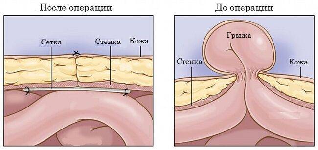 pupochnaya-gryzha-operatsiya