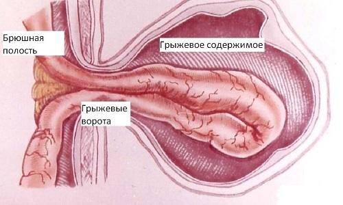 pupochnaya-gryzha-u-vzroslyh-lechenie-bez-operacii