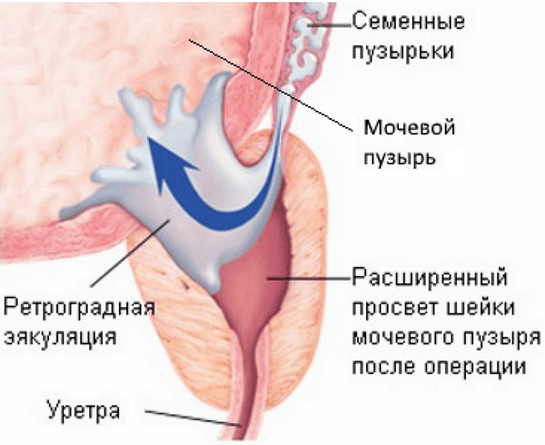 retrogradnaya-eyakulyaciya-2