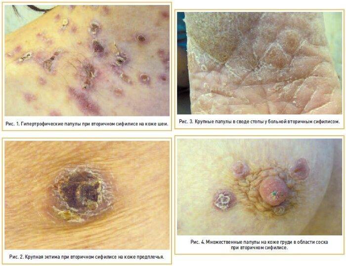 sifiliticheskaya-infektsiya-simptomy-u-zhenschin-3