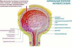 simptomy-zabolevaniya-neironnogo-mochevogo-puzyrya