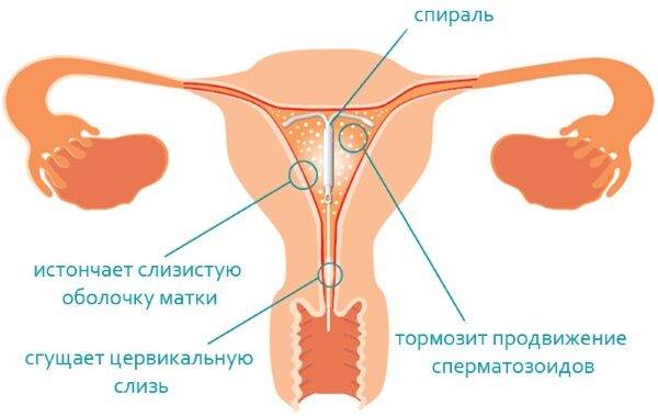 spiral-ot-beremennosti-2