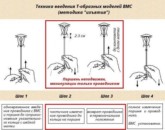 spiral-ot-beremennosti-3