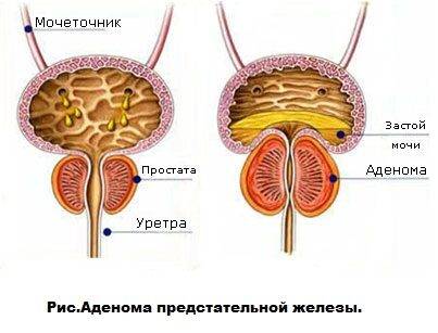 stepeni_adenomy_prostaty