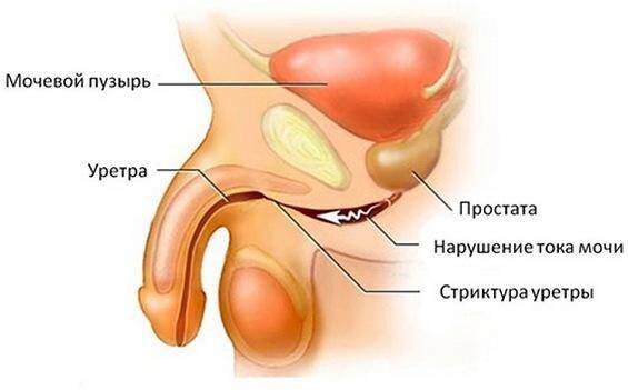 striktura-uretry