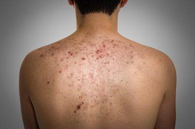 acne-scars-and-keloids-in-the-back-of-young-man