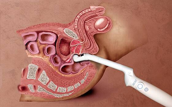 ultrazvukovoye-issledovaniye-prostaty