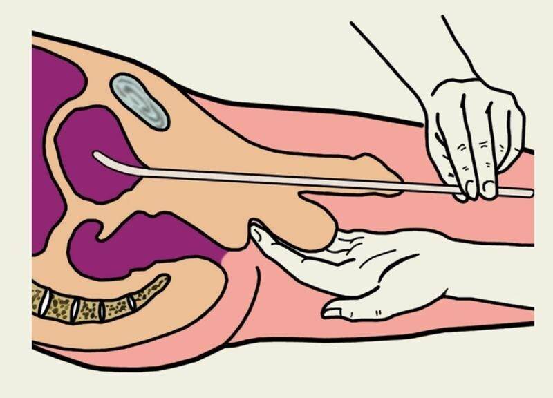 uretralnaya-kateterizatsiya