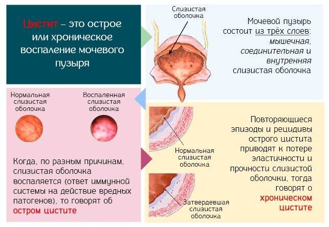 uretrit-u-zhenschin-5