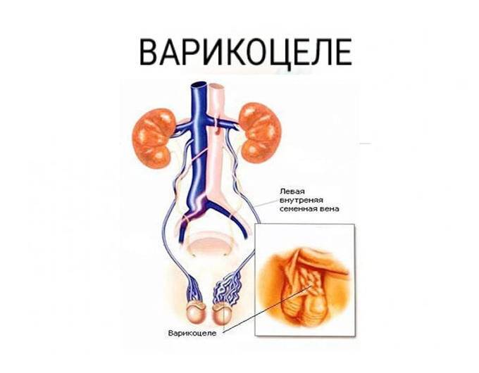 varikocele_i_potencija1-min-1