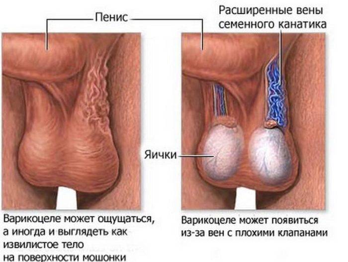 varikotsele-e1548113410381